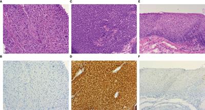 Prevalence of Transcriptionally Active HPV Infection in Tumor-Free Oropharyngeal Tissue of OPSCC-Patients